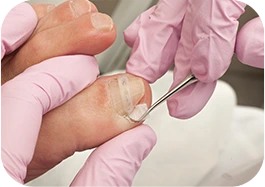 Ingrown Toenails